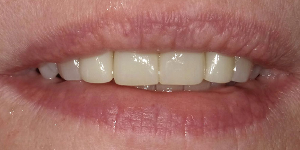 Vorher/nachher Beispiele von CEREC Zahnsanierungen